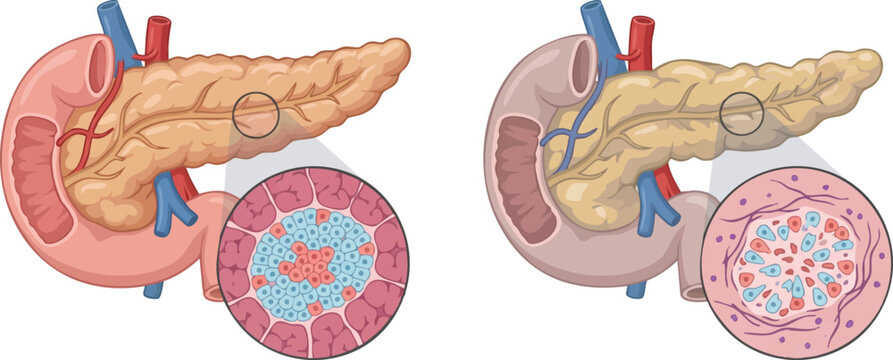 Detailed Comparison of Healthy Pancreas and Autoimmune Pancreatitis with Beta Cell Destruction
