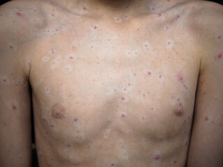 Naklejka premium Horizontal close up of child chest showing contagious chickenpox virus infection, medical shot of skin rash with red itchy spots, varicella blisters and healing pimples on body.