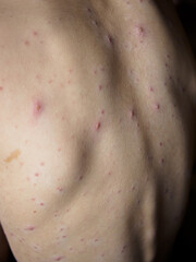 Naklejka premium Vertical macro shot of contagious chickenpox rash on child back skin, side view of painful red virus spots, varicella blisters and itchy pimples on little patient body.