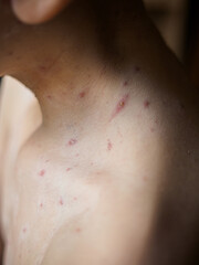 Fototapeta premium Vertical closeup of red chickenpox virus spots and fluid-filled blisters on kid skin. painful contagious varicella rash on child shoulder and neck before medical ointment treatment.