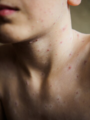 Fototapeta premium Vertical photo of viral chickenpox rash on child body, close up of skin infection with red itchy spots, inflamed varicella blisters and pimples on neck, chest and chin of patient.
