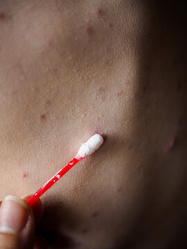 Vertical close up of applying soothing white zinc cream on chickenpox virus skin rash using cotton bud, treatment of itchy red spots and varicella blisters on patient body, medical skin care.