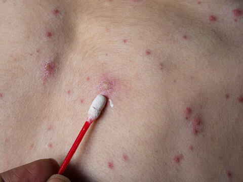 Horizontal close up of medical cotton stick applying white zinc lotion on chickenpox virus skin rash, treating painful red spots, inflamed blisters and itchy varicella pimples on body.