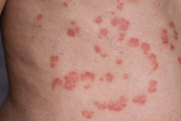 Fototapeta premium Close-up view of psoriasis on a human back, displaying red patches and lesions with visible skin texture and variations in color and surface