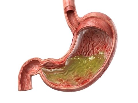 Human stomach with excess gastric acid 3D illustration. Cross section view of stomach interior with acid reflux, heartburn, indigestion, and damaged mucosa lining.