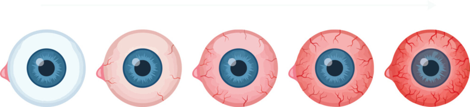 Progressive infographic illustrations of a single eyeball showing growing redness from healthy to bloodshot