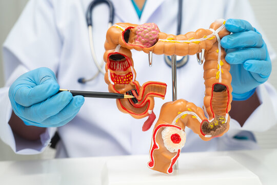 Colorectal cancer, doctor holding intestine colon human anatomy model.