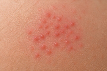 Fototapeta premium A close-up of skin exhibiting multiple small, red bumps or rash spots.