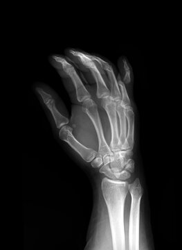 X-ray of human hand showing dislocation of the little finger (fifth finger), Oblique view