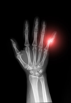X-ray of human hand showing dislocation of the little finger (fifth finger), AP view on black background. Medical radiograph of bones, joints, metacarpals and phalanges for radiology.