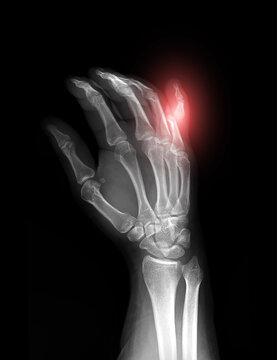 X-ray of human hand showing dislocation of the little finger (fifth finger), Oblique view