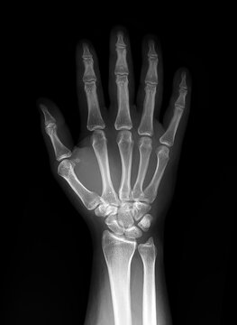 X-ray of human hand and wrist on black background, anteroposterior (AP) view .