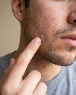 Man applying acne patch on his cheek. Closeup of male face skin care routine with hydrocolloid sticker. Treatment for pimple and blemish. Health and beauty concept for problem skin.