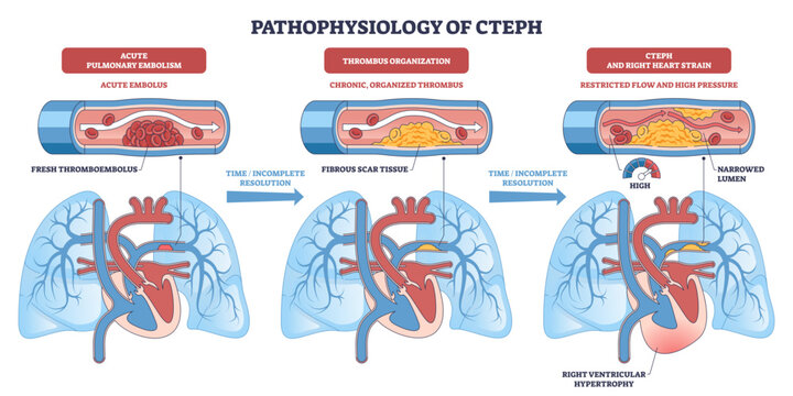 Pathophysiology of CTEPH depicts embolus becoming organized thrombus, narrowing pulmonary arteries and causing right ventricular strain, vessels, lungs, heart, transparent background