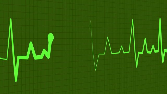 Heartbeat line on graph paper showing an irregular ecg pattern with a flatline section animation