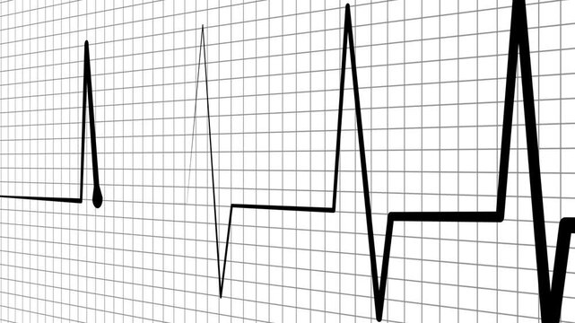 Ecg heart rhythm line on graph paper showing pulse spikes and flat line animation