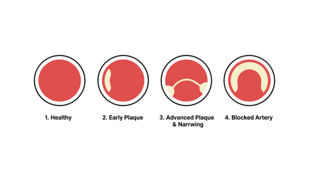 Four stages of arterial plaque development showing healthy, early plaque, advanced plaque, and blocked artery conditions.