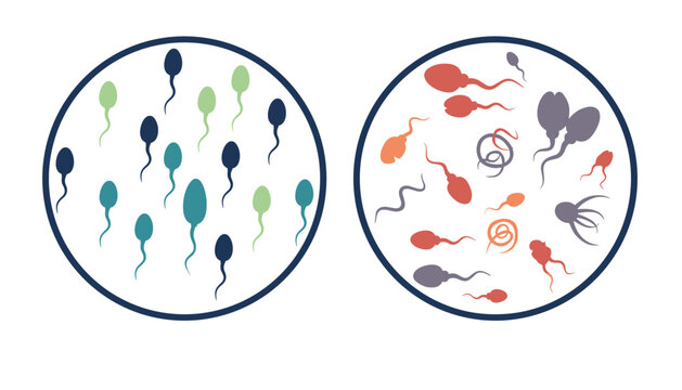 Semen analysis and male fertility testing infographic showing normal healthy sperm versus abnormal deformed sperm cells.