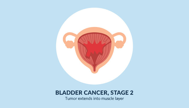 Bladder cancer stage two medical diagram showing a red tumor extending deep into the muscular wall of the bladder.