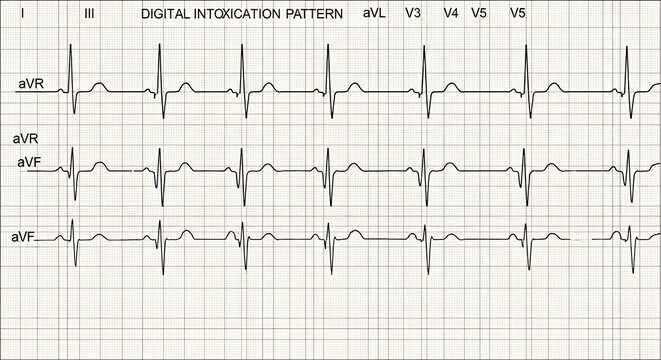 A 12-lead electrocardiogram printout displaying a digital intoxication pattern