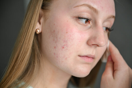 Young woman with acne-prone skin removing makeup and cleansing face with cotton pad. Daily skincare routine for problematic skin, beauty and dermatology concept.
