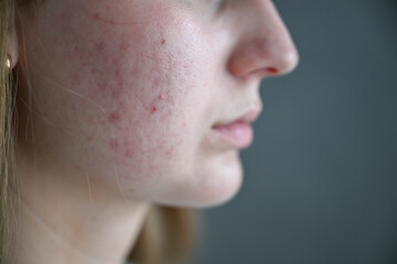 Side profile portrait of young woman with acne-prone skin. Dermatology, skin condition and facial health concept.  © Liudmila