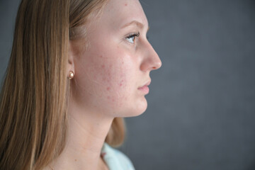 Side profile portrait of young woman with acne-prone skin. Dermatology, skin condition and facial health concept.  © Liudmila