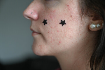Side profile portrait of young woman with acne-prone skin. Dermatology, skin condition and facial health concept.  © Liudmila