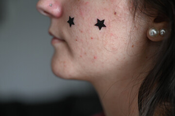 Side profile portrait of young woman with acne-prone skin. Dermatology, skin condition and facial health concept.  © Liudmila