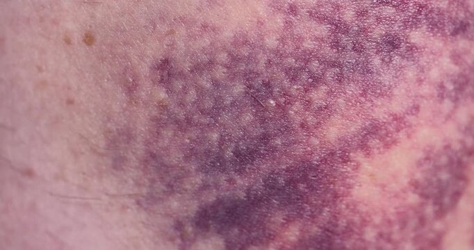 The bruise mark is purple, the bruise is located on the skin surface of a person after suffering severe pinching.