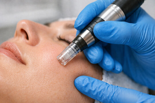 Close-up of professional microneedling treatment with practitioner wearing blue medical gloves, using cosmetic device on facial skin in clean clinical environment with focus on precision skincare.
