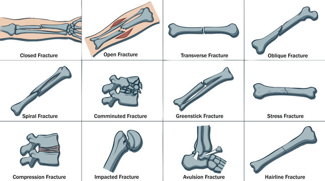 Comprehensive Medical Diagram Illustrating Various Human Bone Fracture Types and Their Classifications