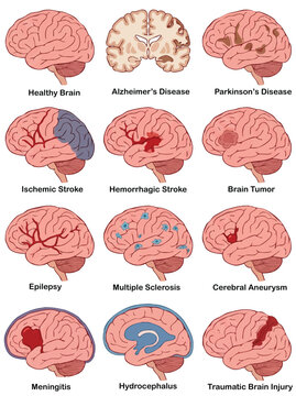 Medical illustrations detailing various neurological diseases, health conditions, and traumatic brain injuries affecting human cerebral function