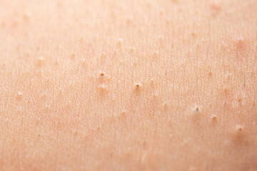 Fototapeta premium Acne on skin closeup photo. Skin inflammation with whiteheads and acne detail. Close up epidermis with inflamed follicles and acne. Detailed skin with acne.