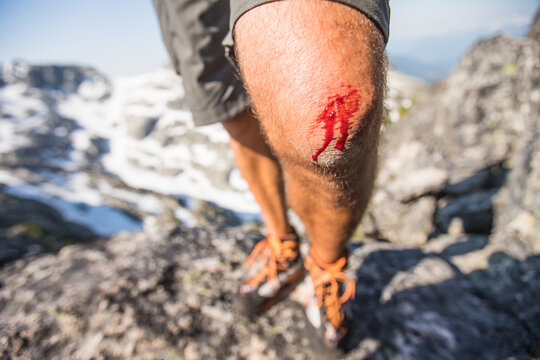 Close up of hiker's bloody knee after a fall