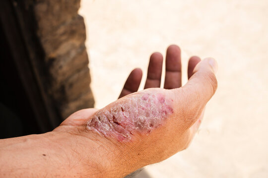 Medical close up of inflamed skin rash on hand with dermatitis inflammation psoriasis irritation dermatology condition