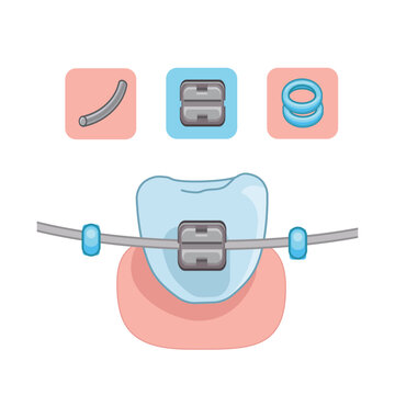 Orthodontic Braces Components and Parts Illustration