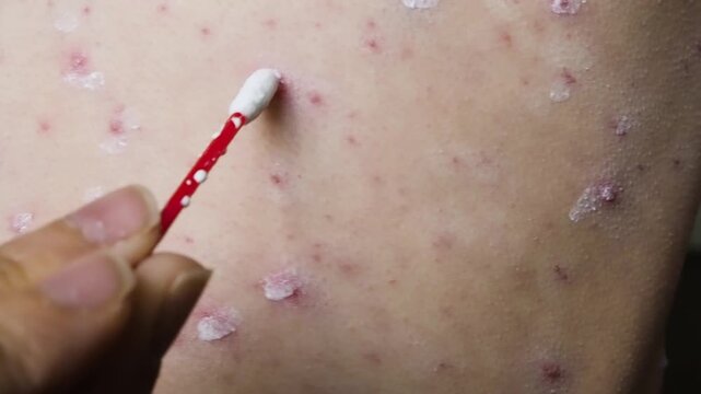 Horizontal close up video of medical cotton stick applying white zinc lotion on chickenpox virus skin rash, treating painful red spots, inflamed blisters and itchy varicella pimples on body.