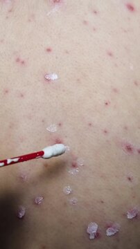 Vertical close up video of cotton bud applying white ointment on chickenpox rash, treatment of itchy varicella blisters and red pimples on patient skin, medical care concept.