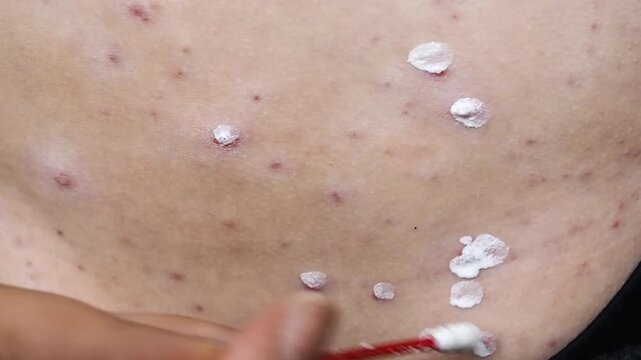 Horizontal macro video of cotton swab applying white medical cream on chickenpox skin rash, treatment of itchy varicella blisters and red pimples on body,  dermatology virus care concept.