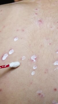 Vertical video of treating multiple chickenpox spots on back skin with cotton bud, medical skin care for viral rash, relieving itch and healing red varicella blisters on infected person body.