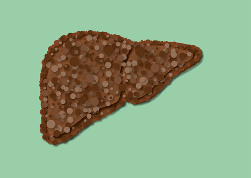 Liver cirrhosis, illustration