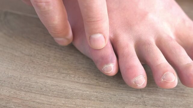 A close-up of a man&rsquo;s swollen foot with a bruise. A severe bruise to the toes. The man shows his swollen foot.