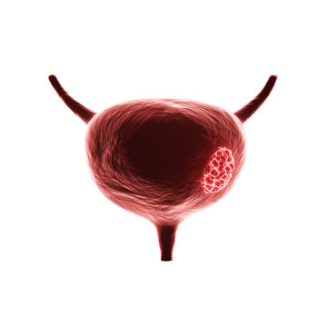 Glowing urinary bladder on white background background. Urinary bladder cancer illness concept. 3d-rendering