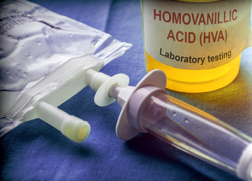 Urine collection container for Homovanillic Acid (HVA) analysis in a laboratory, conceptual image