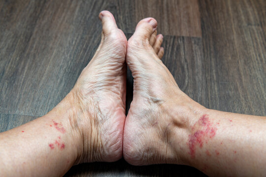 Red rash on the interior ankles of a woman with a shallow depth of field