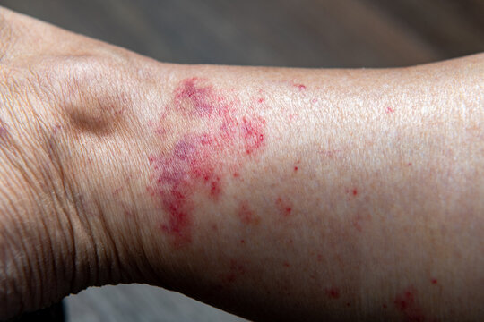 Red rash on the interior ankles of a woman with a shallow depth of field