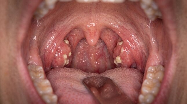 Close-up view of a human throat showing tonsillitis with white spots on tonsils.