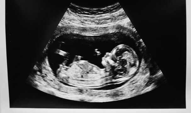 First-Trimester Obstetric Ultrasound (12 Weeks Gestation).