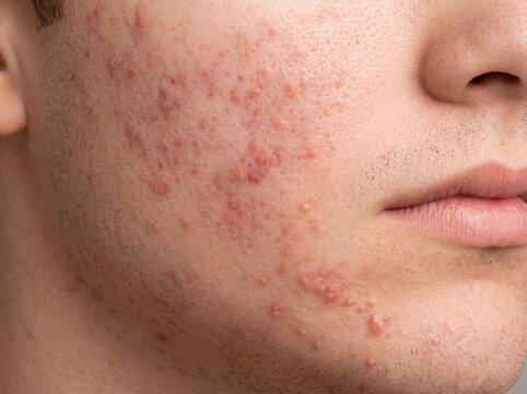 Acne vulgaris breakout on young male jawline and cheek